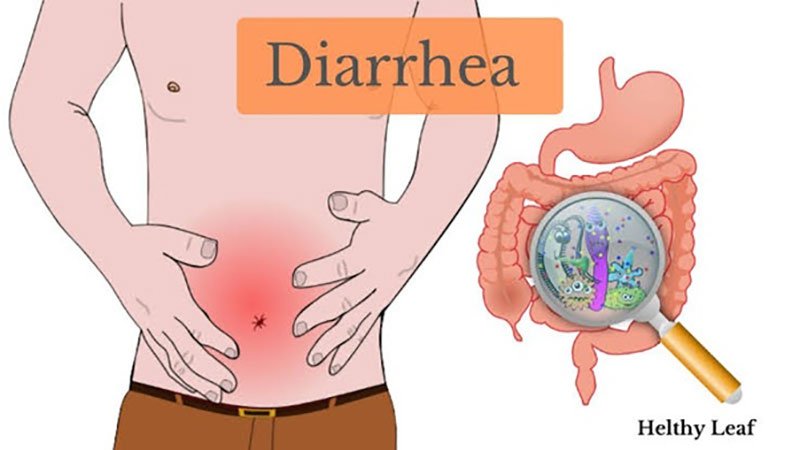 مشکلات روده در اسهال آبکی بزرگسالان